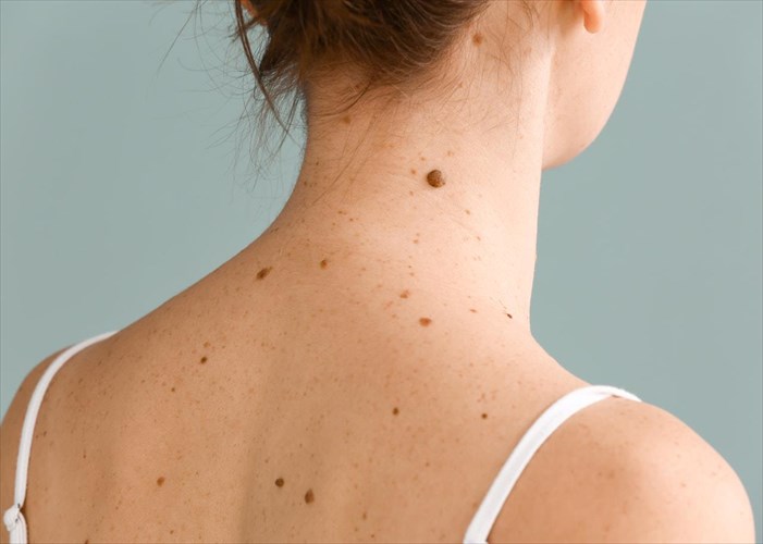 melanoma-pos-na-to-katalabete-egkairos