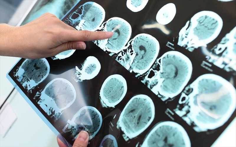 nea-eksetasi-diagignoskei-ton-karkino-tou-egkefalou-se-30-lepta