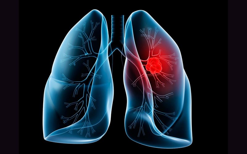 9-ixni-pou-prominuoun-karkino-tou-pneumona-ixni-pou-prominuoun-karkino-tou-pneumona