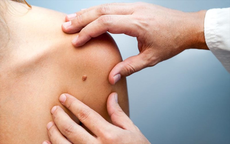 melanoma-pote-mia-elia-einai-upopti-kai-ti-kanoume-meta